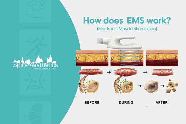 EMS treatment for post pregnancy weight loss treatment Burnley