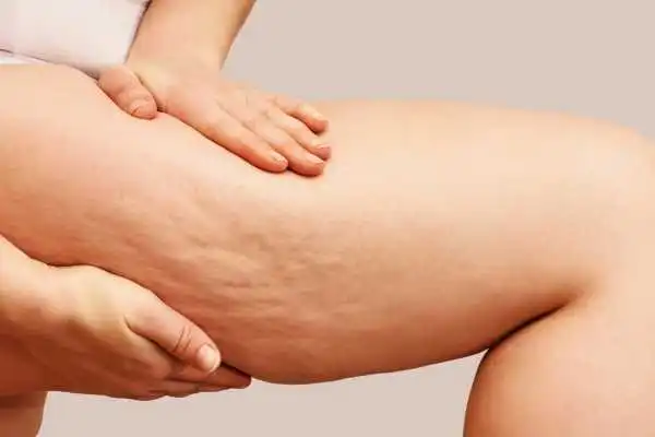 Image of woman showing leg with cellulite Burnley