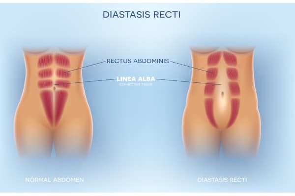 What Non-Surgical Options Are Available for Diastasis Recti Burnley?
