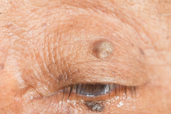 Skin imperfections Burnley - Cryopen is fast and effective book in today!