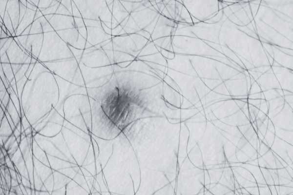 Dermatofibroma removal Burnley made simple! Book in today!