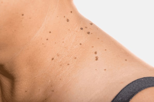 Are you looking for easy skin tag removal Burnley - then contact Spire today!