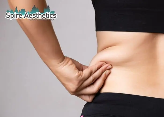 Image of woman pinching fat on their hips Burnley. Fat Freezing treatment 