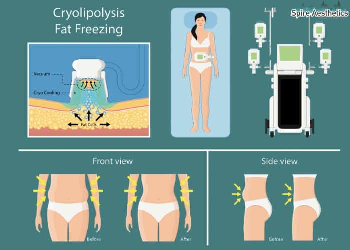 Image of diet and fat freezing combined for best results for Spire Aesthetics Burnley