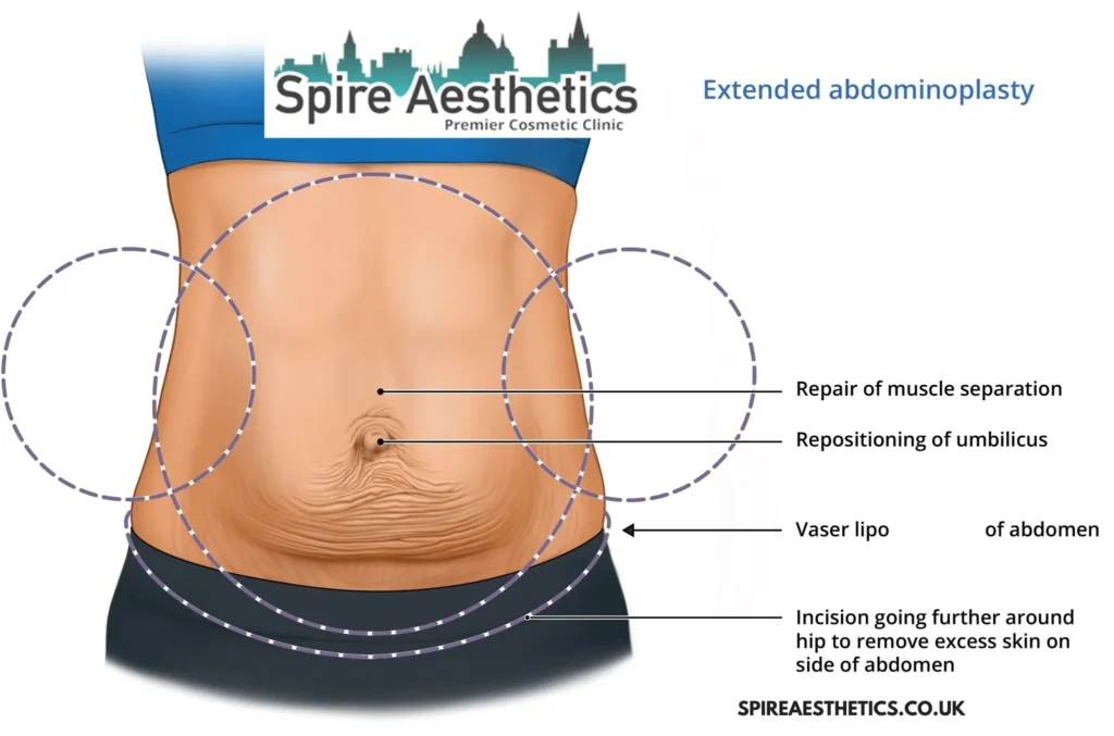 Understanding Loose Skin After Gastric Band Burnley Surgery and HIFU Treatment