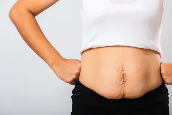 Image of a woman's stomach after weight loss with sagging skin following a gastric band Burnley