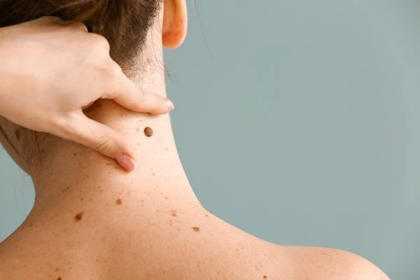 Prices and promotions for blemish removal Burnley contact our team today!
