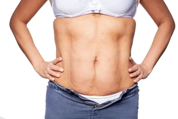 sagging skin on woman's stomach after weight loss injections Burnley