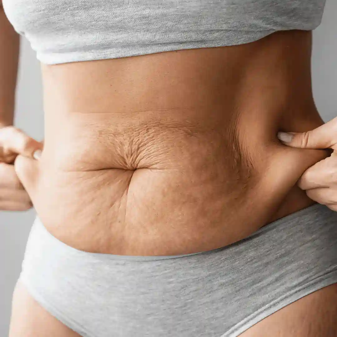 Is It Normal to Have Loose Skin After Pregnancy Burnley?