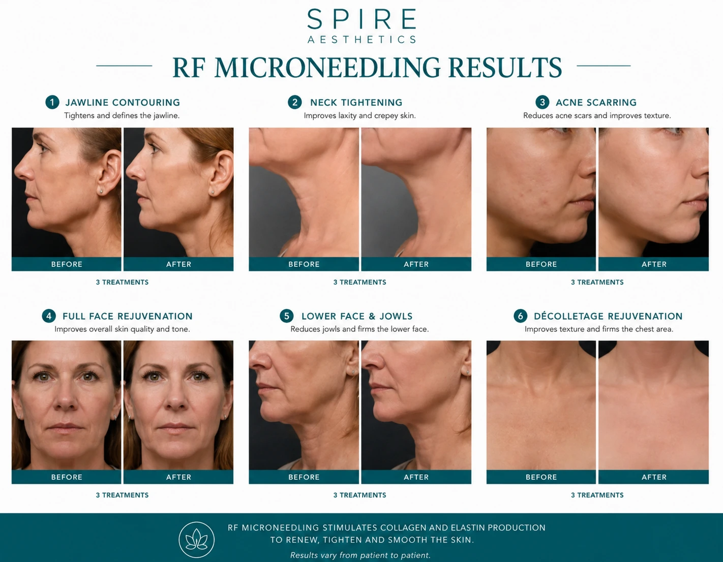 RF Microneedling Skin tightening Burnley results