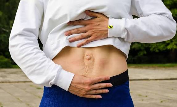 When Could Diastasis Recti Be the Missing Piece of the Puzzle Burnley?