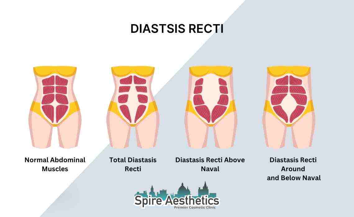 Is Non-Surgical Diastasis Recti Treatment Right for You? Common Concerns Answered Burnley